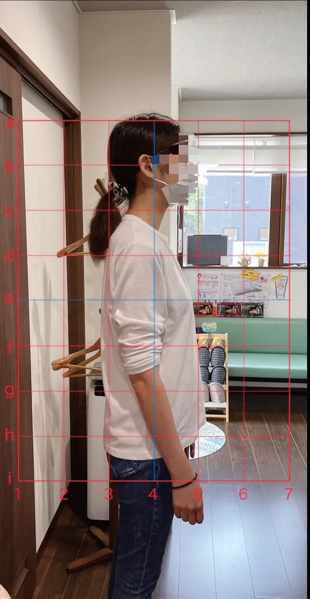 横から撮影した姿勢評価のBefore